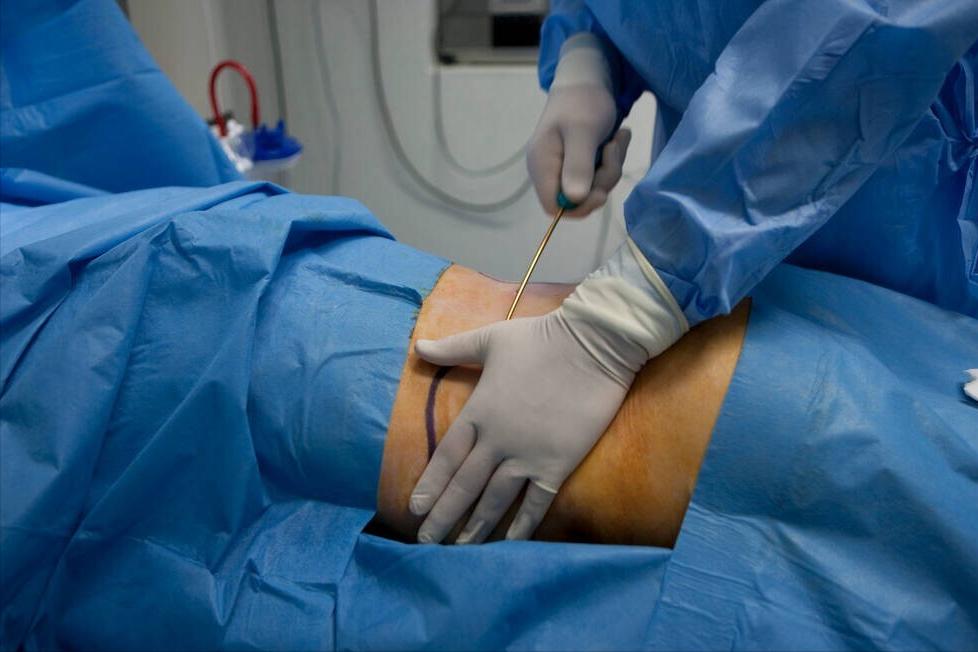 想减肥如何抽脂,警惕抽脂减肥5大误区