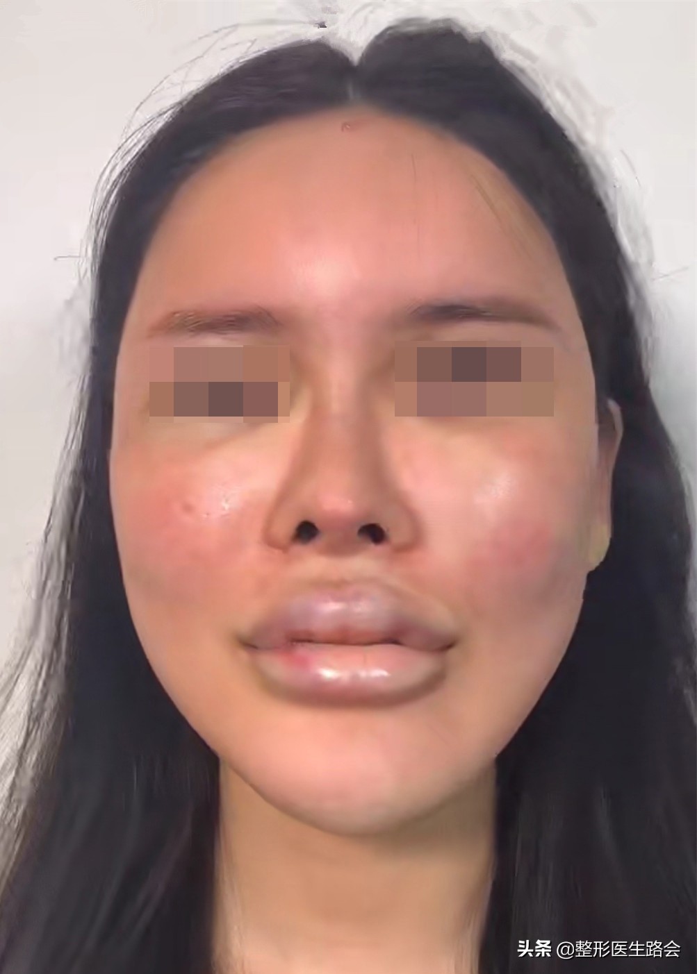 玻尿酸全脸填充年轻化,全脸玻尿酸填充真的会好看吗