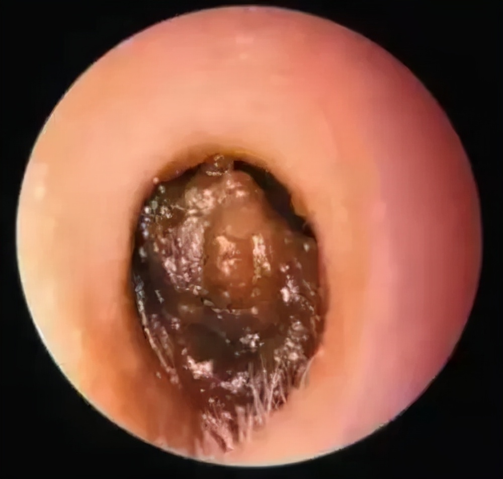 小孩耳朵里面有个硬硬东西怎么办,孩子耳朵里有个小东西能掏出来吗