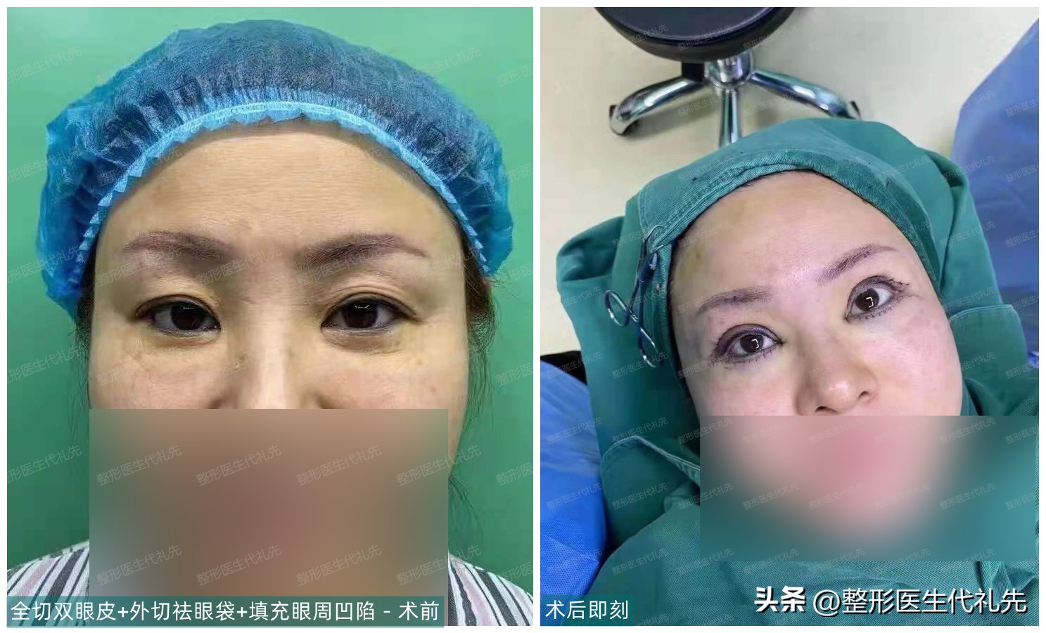 眼袋手术失败了怎么修复,眼袋手术失败哪里可以鉴定