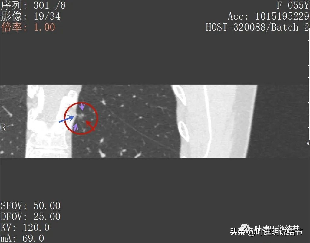 病例分享：这种样子的错构瘤？我是第一次见