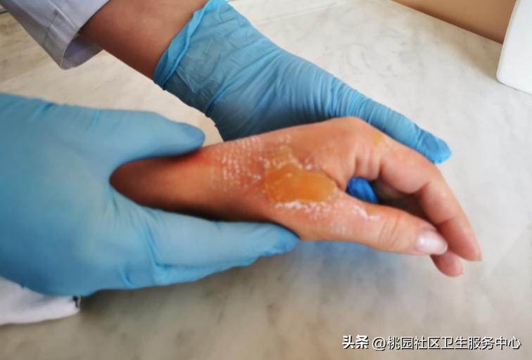 烫伤后抹牙膏怎么洗掉,烫伤涂牙膏酱油有什么作用