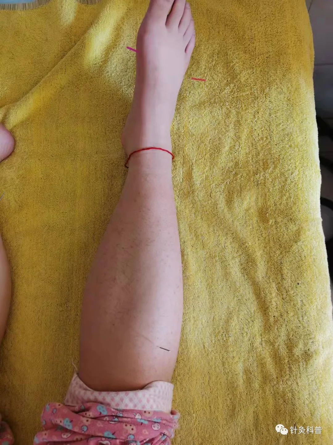 针灸治病治愈案例,针灸治疗妇科杂病视频