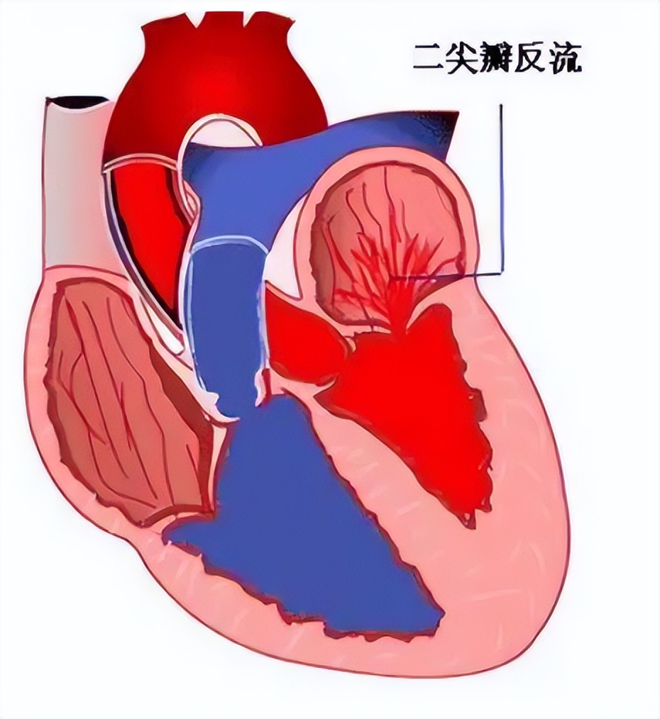 医生用小夹子为4名老人修好心门,76岁大爷心脏抢救