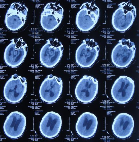 脑外伤后硬膜下积液颅骨修补,颅骨修复手术失败导致脑积水