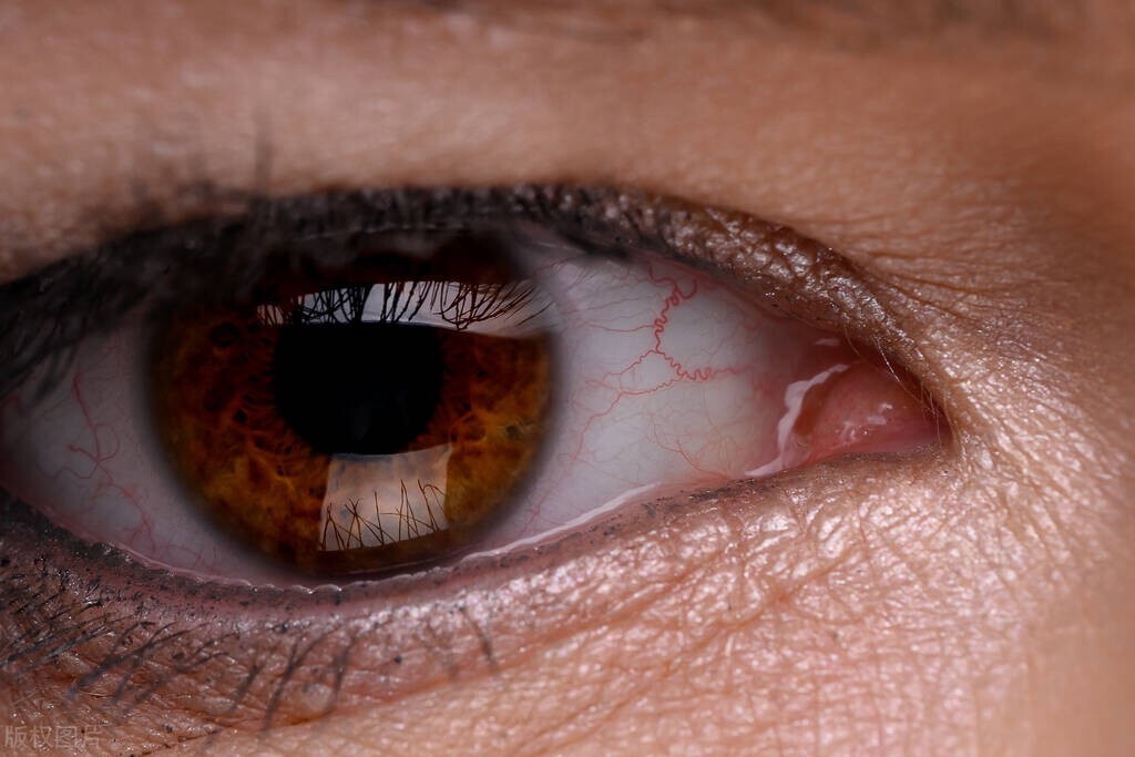 眼底出血视力下降能恢复吗,眼底出血视力下降会恢复吗