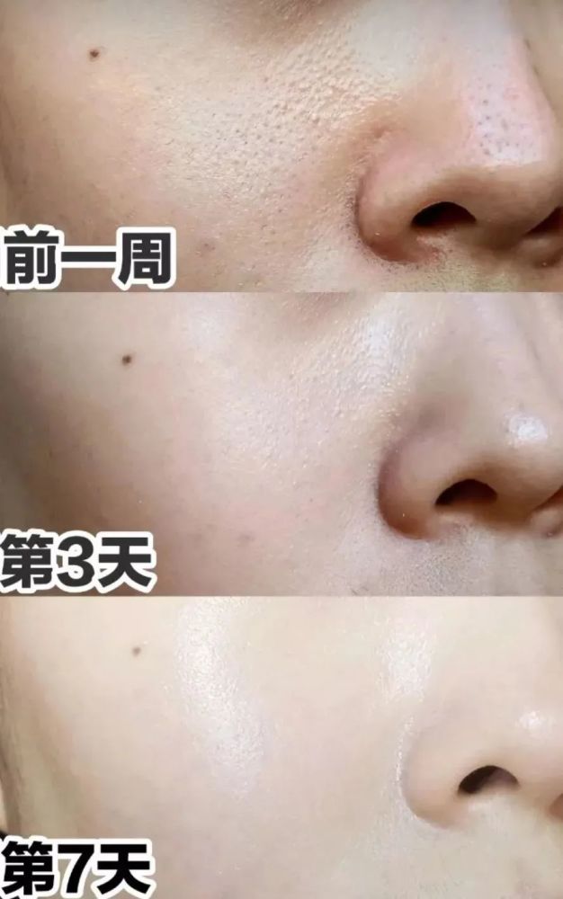 去正规医院皮肤科可以收缩毛孔吗,皮肤科缩小毛孔方法