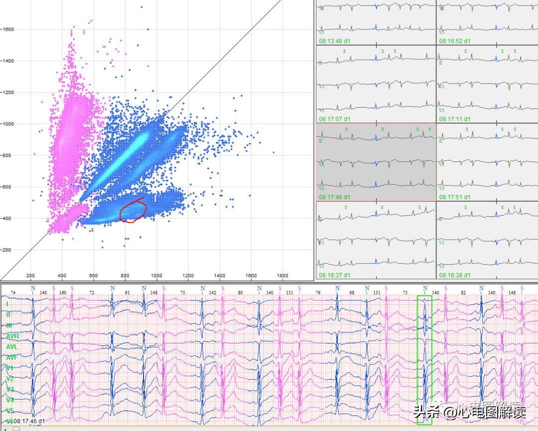 房早室早区别,房早室早房颤