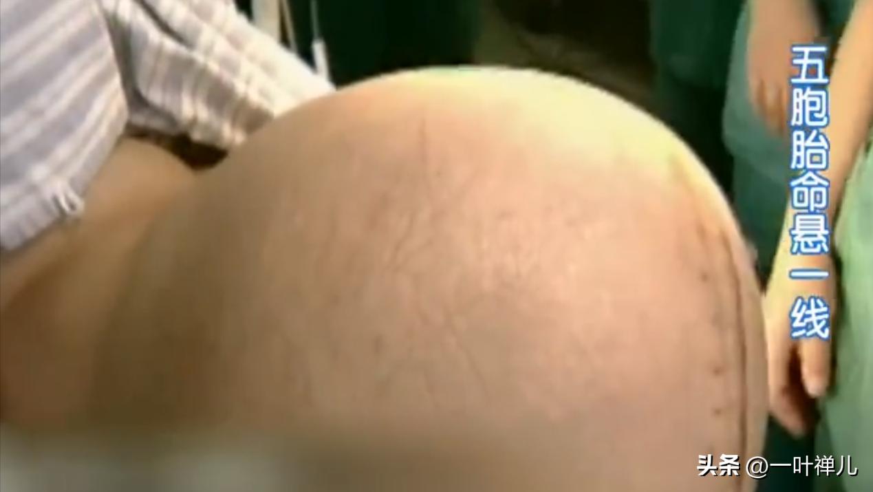 中国首例五胞胎，现年满22岁，妈妈坦言：如果重选，我一个也不要