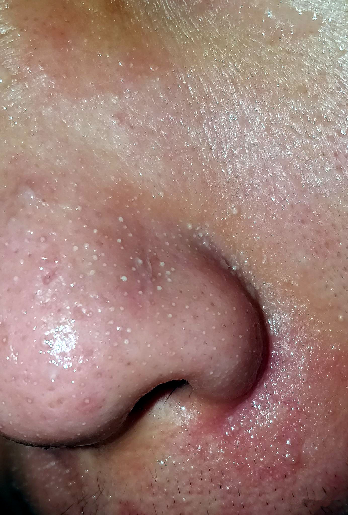 为什么鼻子可以挤出很大的黑头,用夹子挤出鼻子黑头