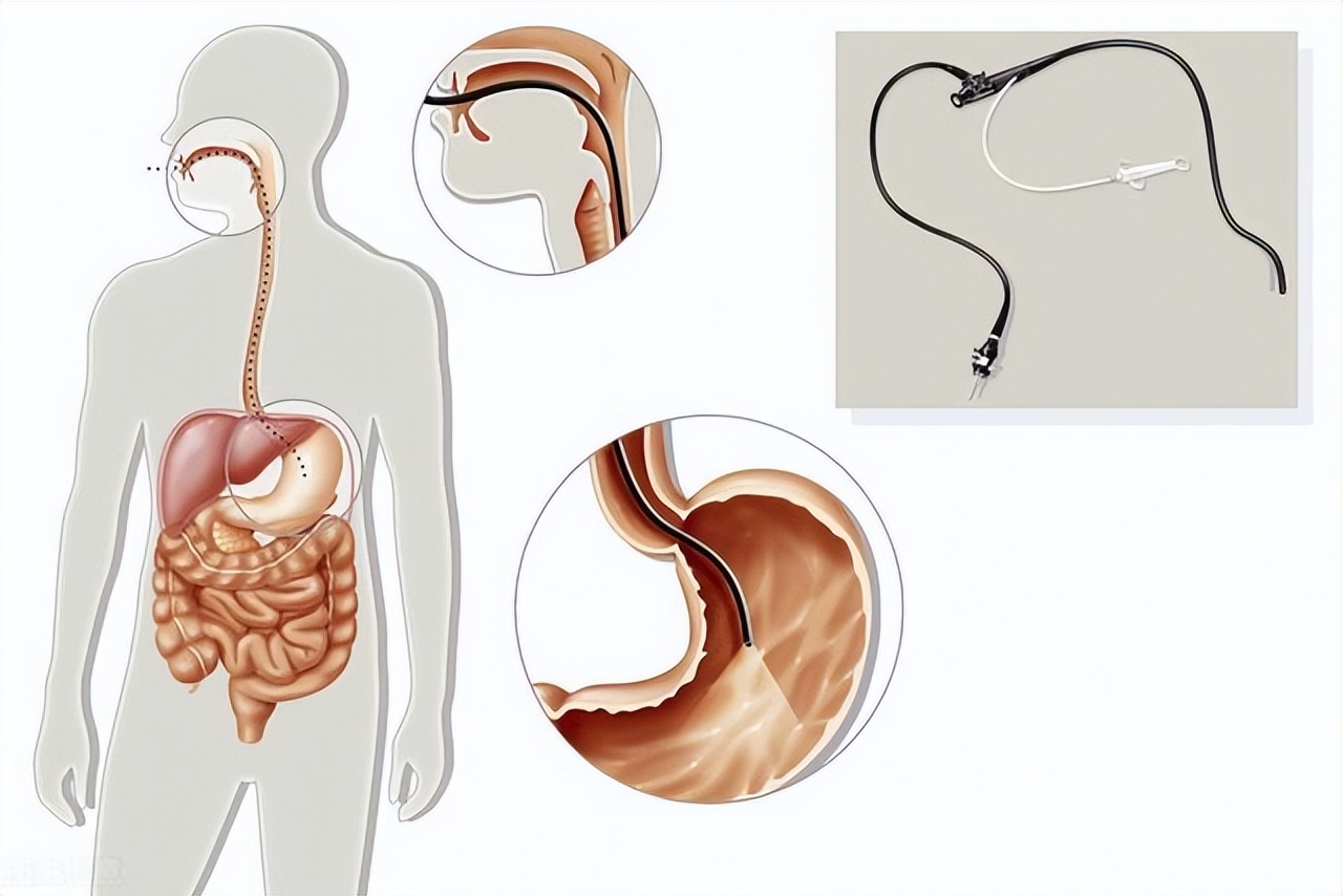 女子吐血不止医生瞬间慌了,女子吐血不止胃部插管