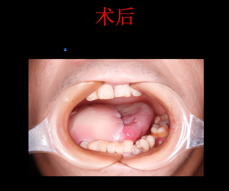 舌头一侧溃疡咽喉癌,舌头溃疡严重会是癌吗