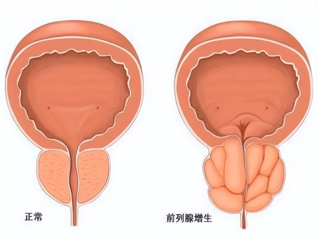西地那非对治疗前列腺肥大有用吗,西地那非治疗前列腺怎么服用
