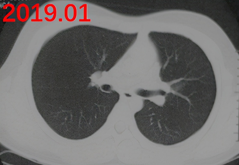 免疫缺陷病会并发什么病,什么是免疫缺陷肺部感染