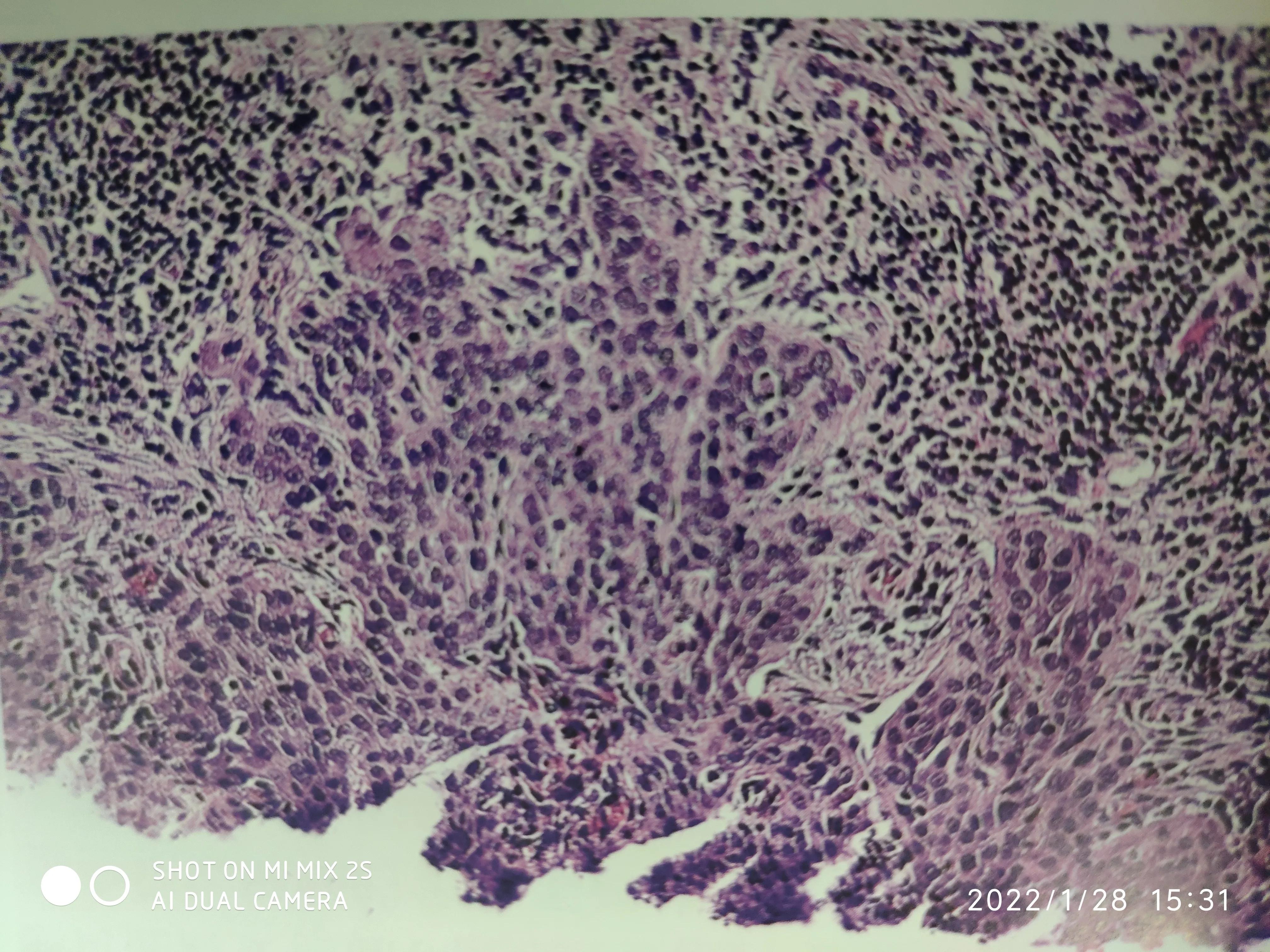 什么是原位癌?与浸润癌有何区别?原位癌会转移吗?