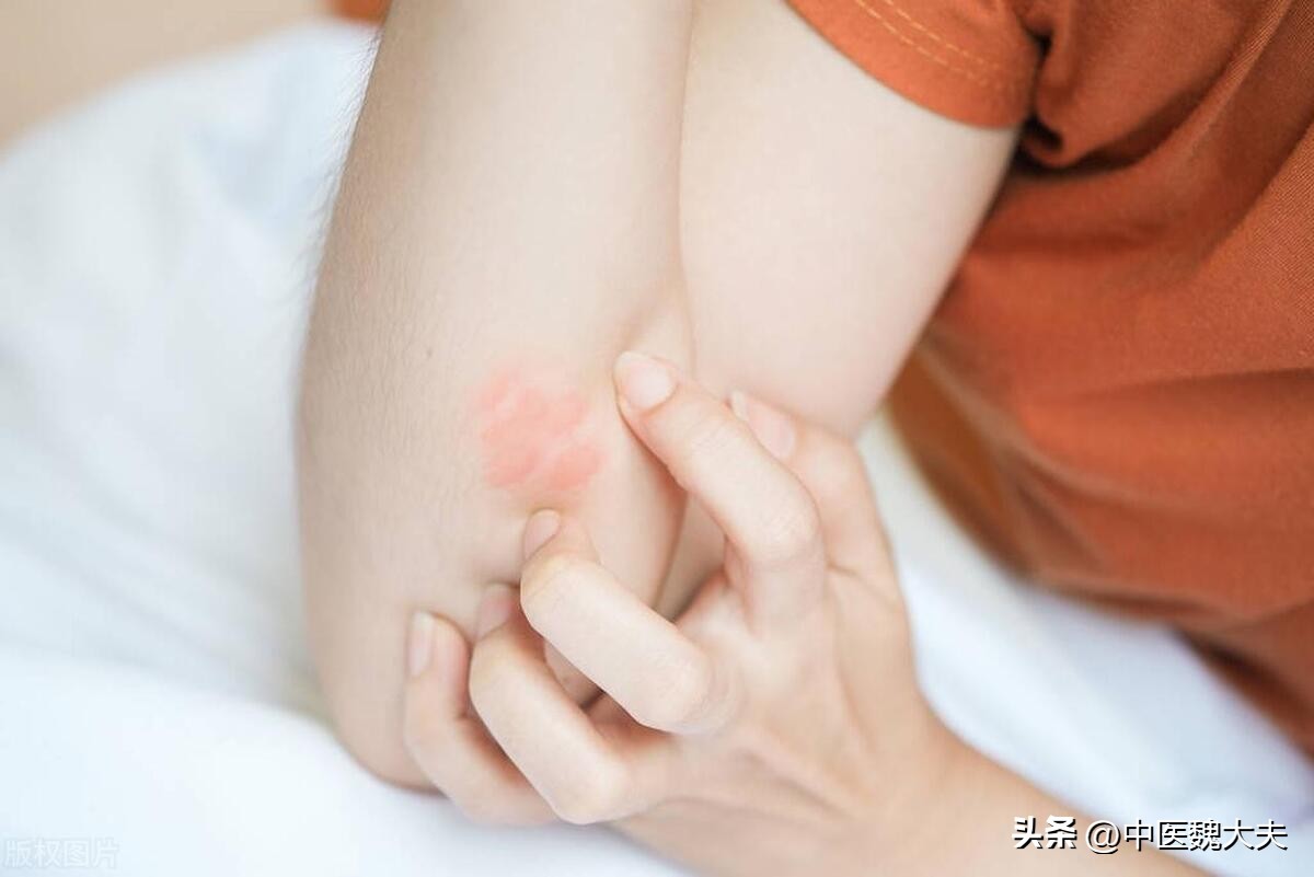 神经性皮炎奇痒难忍用什么药较好,12岁男孩全身奇痒该怎么办