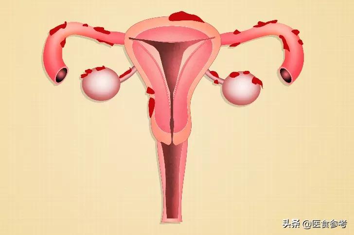 子宫颈癌,男女都要防?这个方法最有效