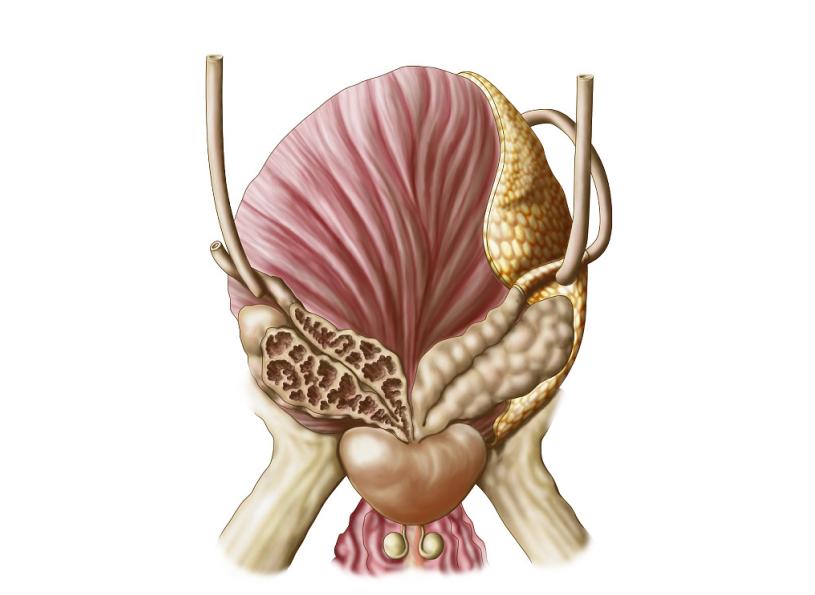 前列腺钙化的5大危害,前列腺钙化有什么危害