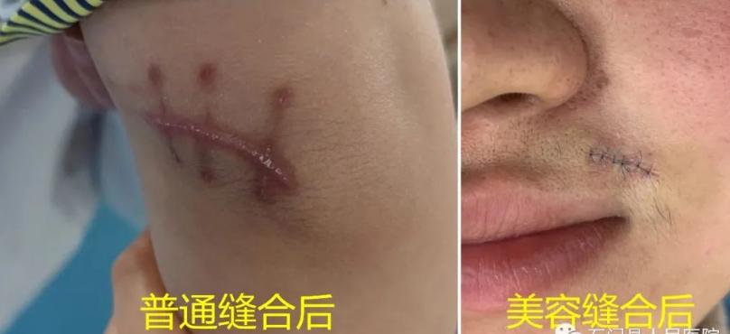 大面积外伤疤痕怎么修复,面部手术留下的蜈蚣疤痕怎么修复