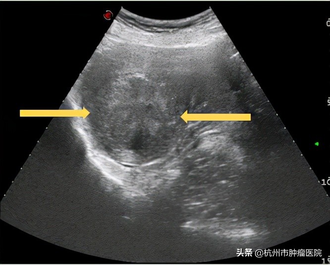 子宫肌瘤的中药克星,拒绝手术选择保守治疗