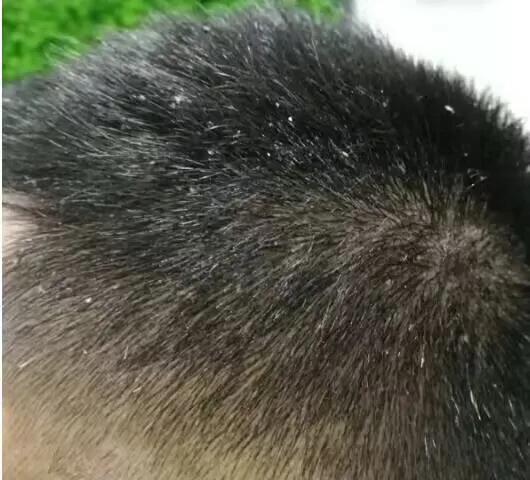 头皮屑多洗头的正确方法,头皮屑怎么处理用什么洗头最佳