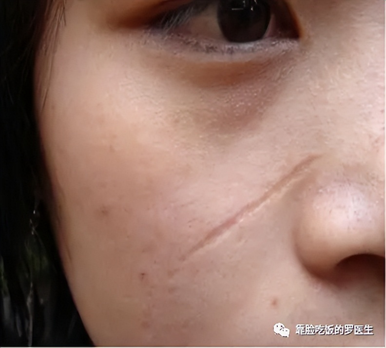 科普疤痕知多少,瘢痕科普视频