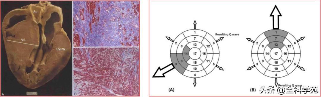 心电图qrs时限超宽严重吗,心电图qrs波形态描述