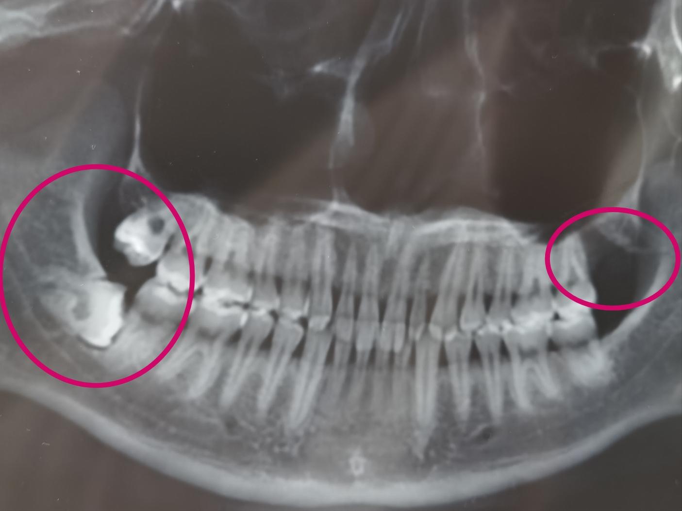 左下智齿拔除视频怎么正确拔除,复杂智齿拔除操作详细流程