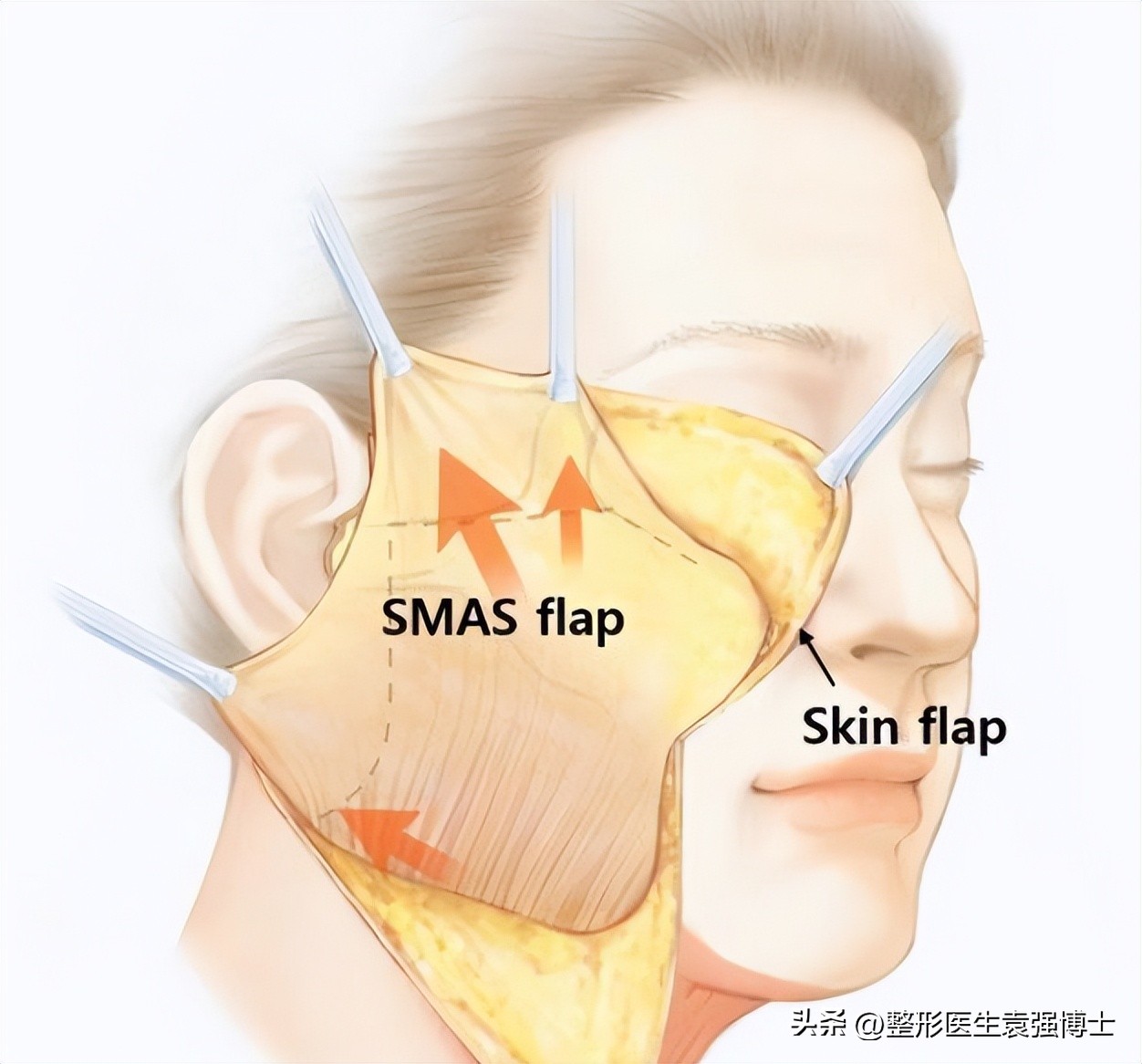 55岁后适合做拉皮手术吗,60岁适合做拉皮手术吗