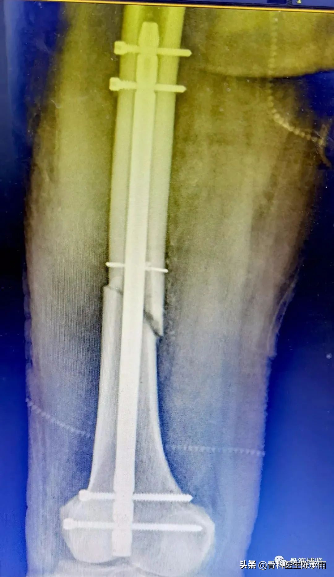 陈旧性腿骨骨折,陈旧性骨折