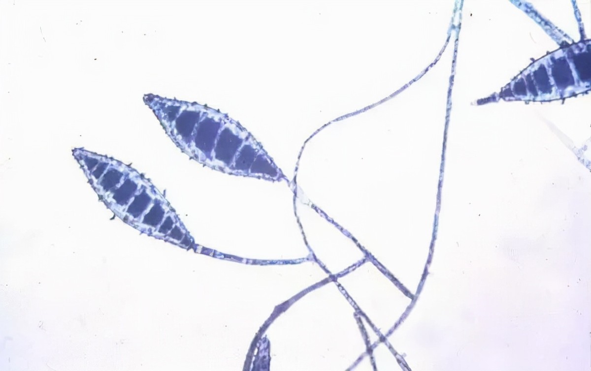 猫癣传染人的症状和治疗,猫癣治疗一般花费多少钱