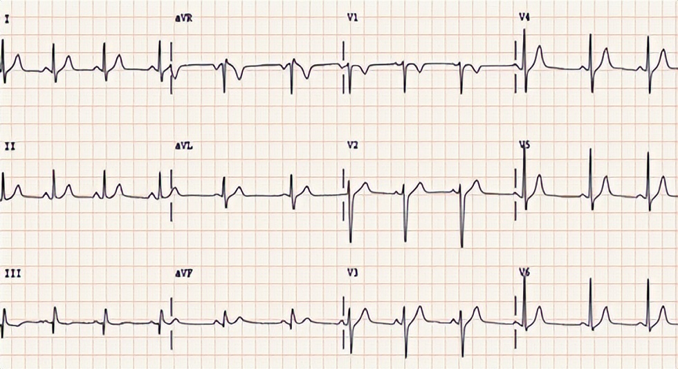 耳垂有折痕会得心梗吗,耳垂上有褶皱就是心脏病前兆吗