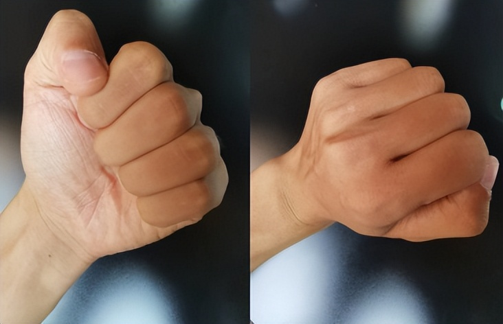 桡骨远端骨折的护理方法,手腕桡骨远端骨折后的恢复过程