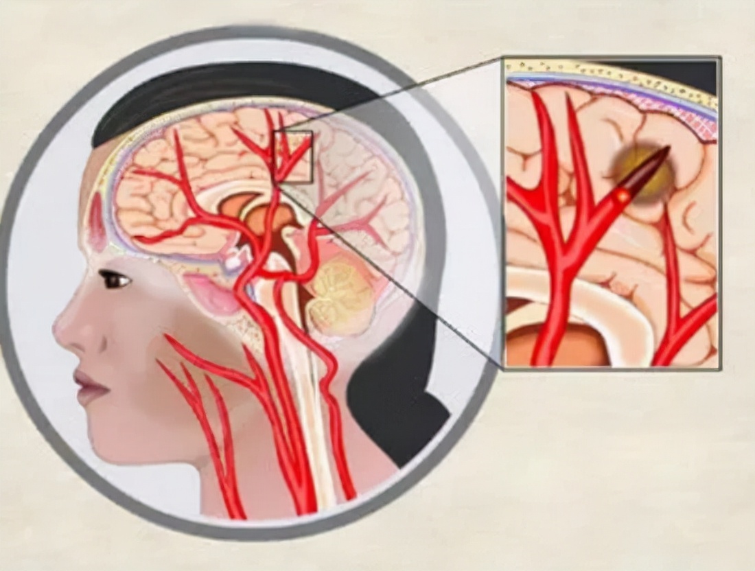 为何如此多的人发生脑梗?要怎么正确应对?一文给您详细讲清楚
