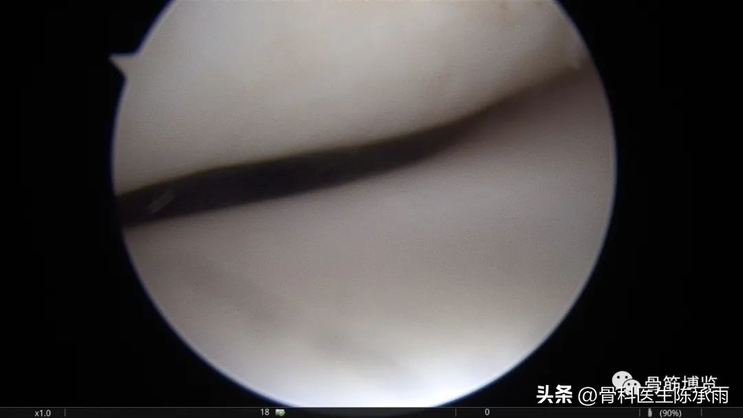 髌骨脱位软骨剥离怎么治疗,半月板撕裂游离体