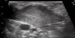 宝宝歪颈和斜颈的症状,婴儿斜颈左侧歪头怎么纠正