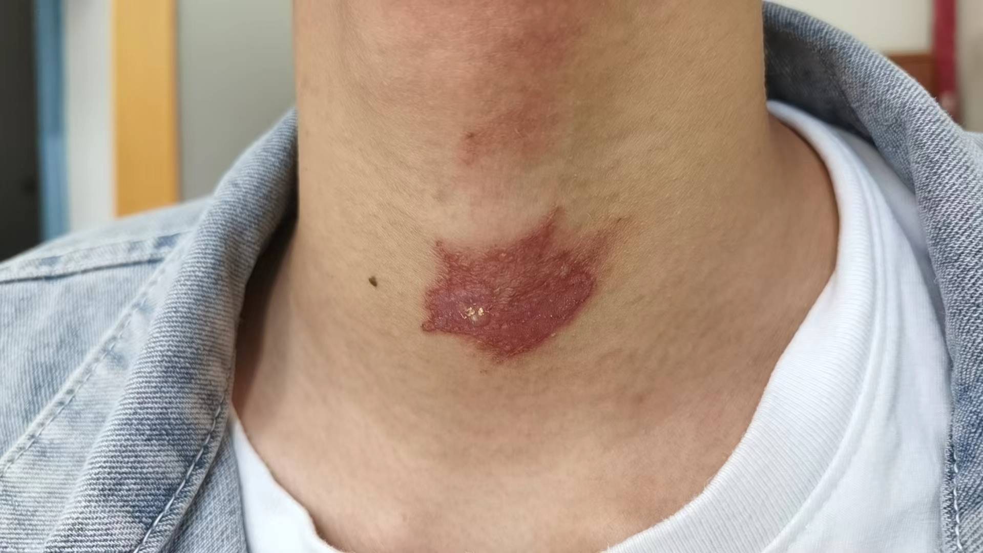 隐翅虫室内防范措施,当心隐翅虫