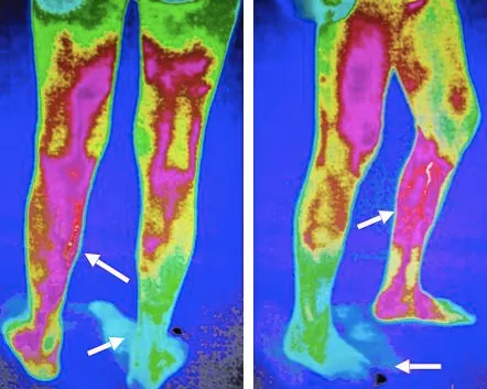 男子治鸡眼致皮肤坏死,男士修鸡眼