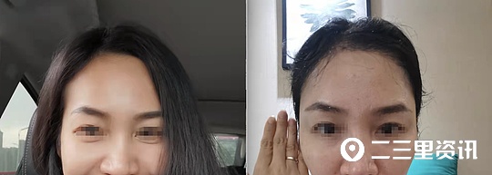 合肥福华整形失败案例,医美整形毁容