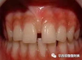 儿童早期牙齿矫正华西,华西口腔小孩矫正牙齿是什么科