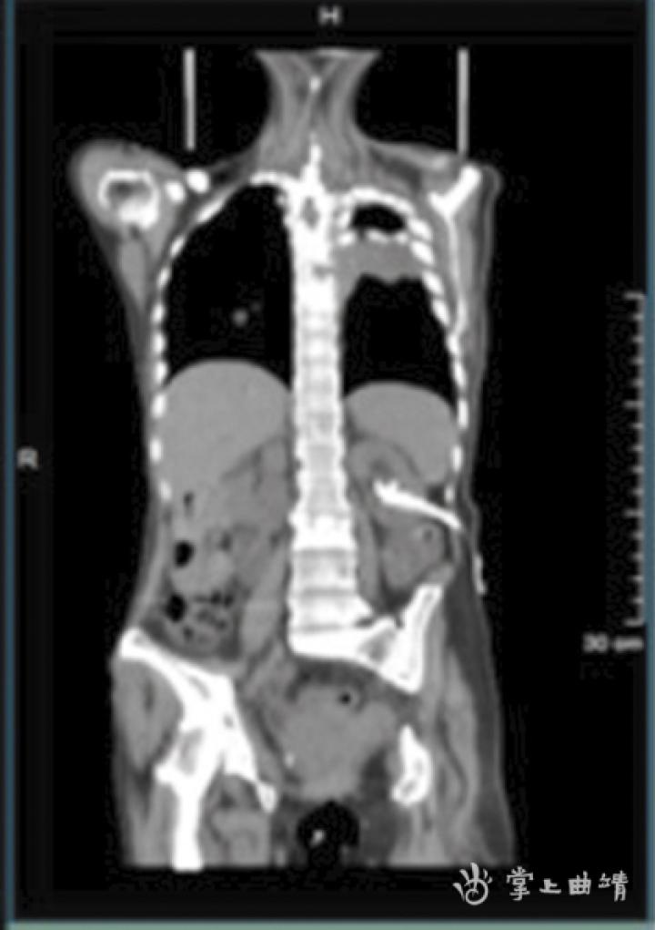 肿瘤检查petct替代方案,肿瘤筛查神器petct