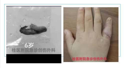 幼儿意外断指家长送医路上迷路,小孩意外断指怎么办