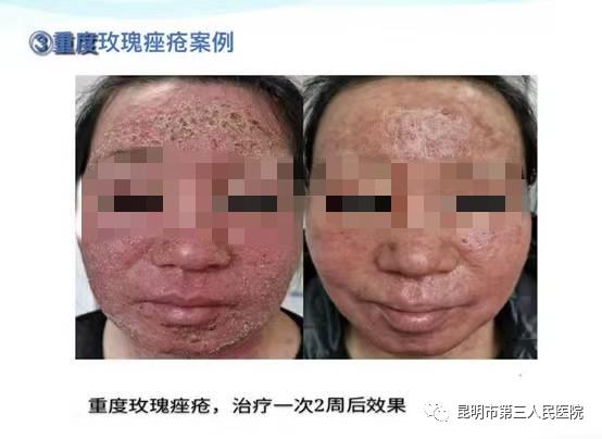 超甜礼遇“6·18”！昆明市三院皮肤科化学换肤术活动来袭