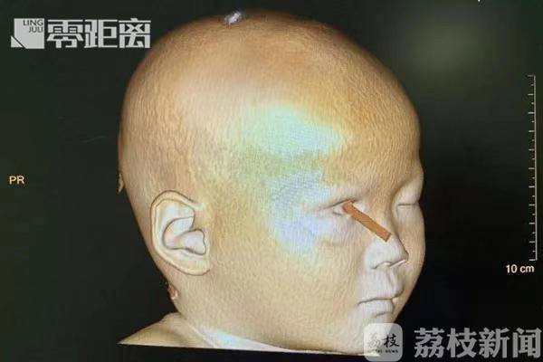 孩子被铅笔扎了眼睛,孩子在校被铅笔刺伤眼球