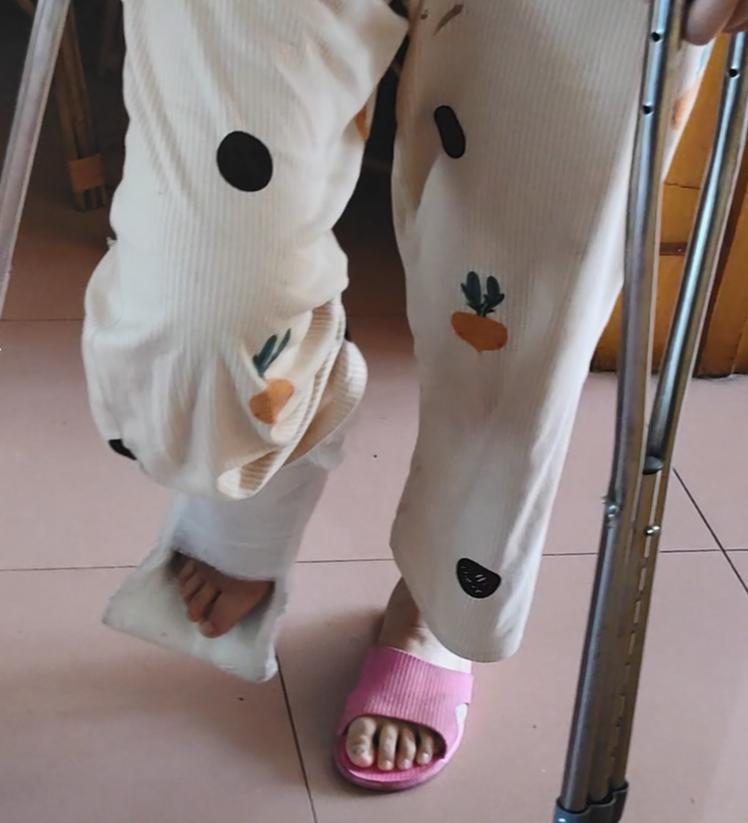 商场上班员工在商场摔骨折了,顾客在店里摔骨折了怎么报警