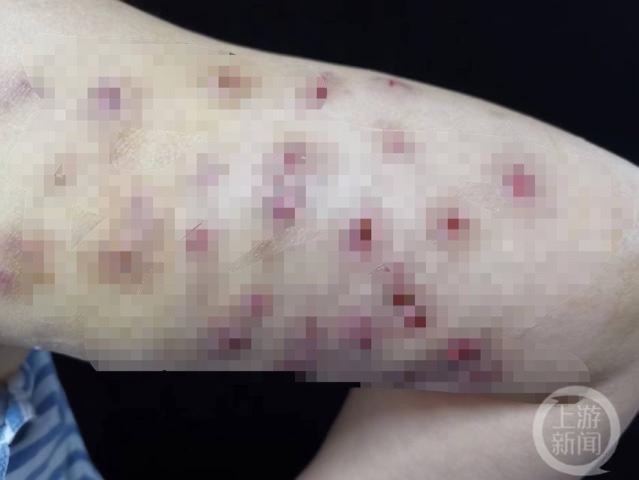 女子注射溶脂针,女子注射美容针后毁容下集