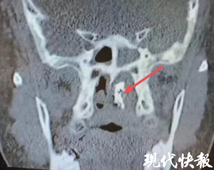 老人流脓鼻涕,老人流黄脓鼻涕用什么药最好