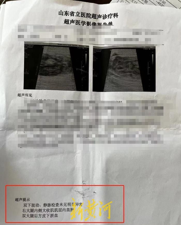 脚部瘀血10天还不消退怎么办,名医治疗双腿瘀血