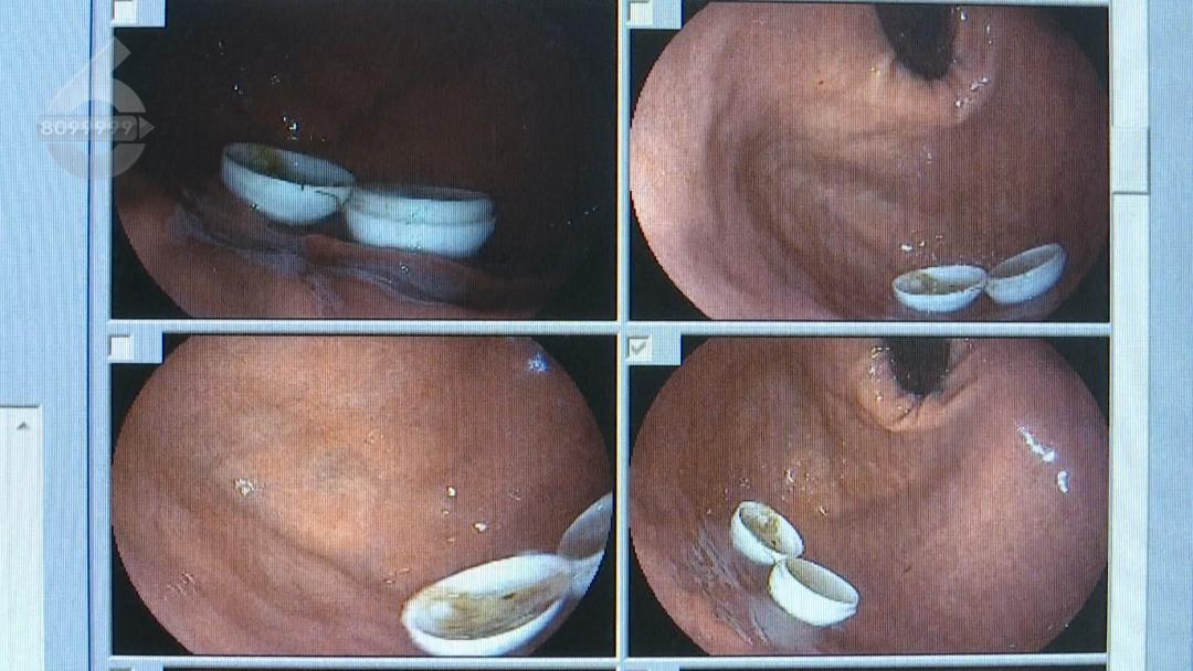 吃牛黄解毒丸后能吃辣吗,男子吃牛黄解毒丸连壳一起吞下
