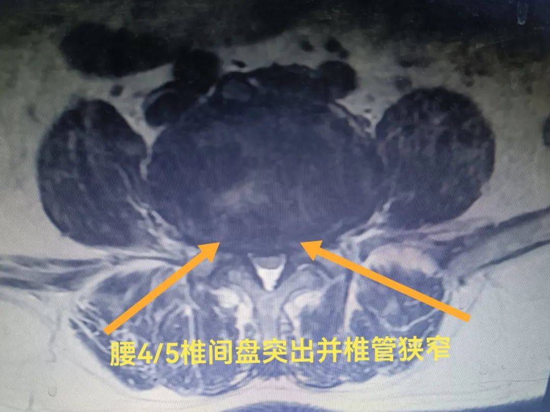 临邑县人民医院治疗腰腿疼,泰安宁阳郭医生治腰腿疼